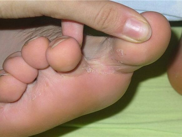 symptômes de mycose des ongles