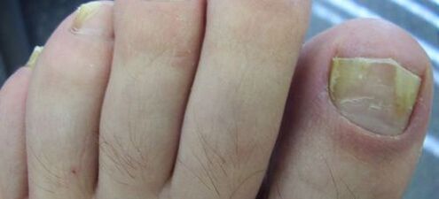 symptômes de la mycose des ongles et son traitement au vinaigre