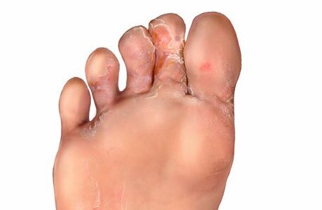 Symptômes de mycose des orteils