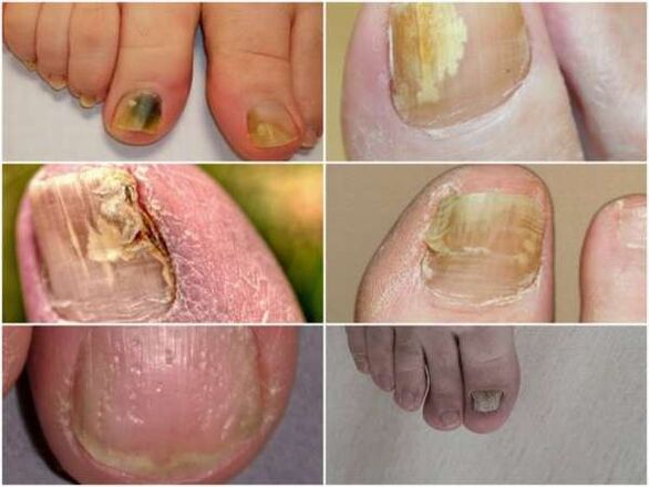 signes de mycose des ongles des pieds